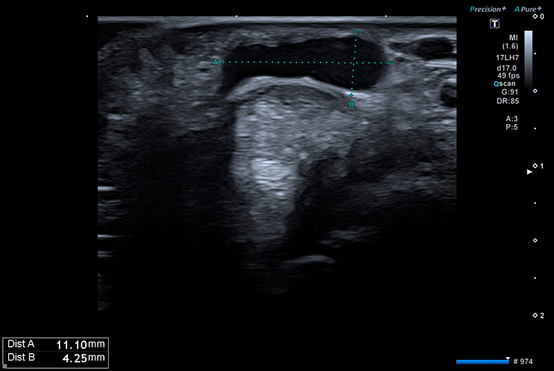 ponction de kyste artrosynovial echo